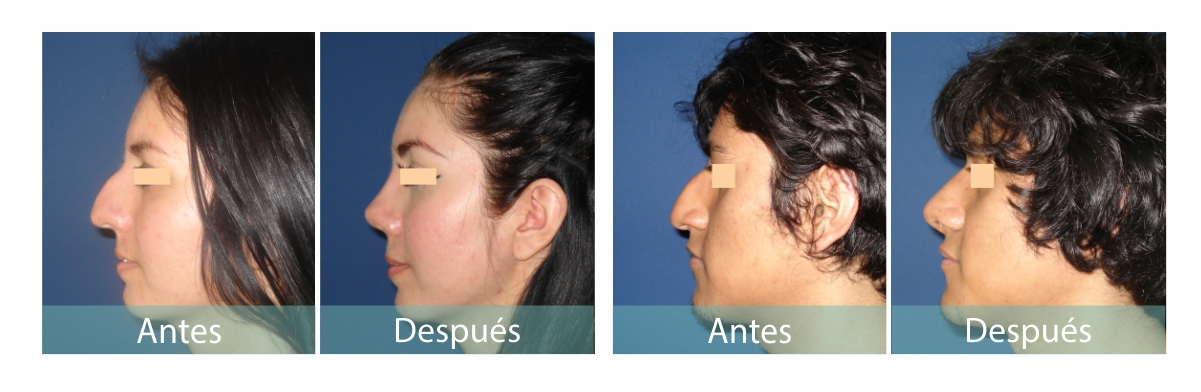 Fotos de Rinoplastia Antes y Despues
