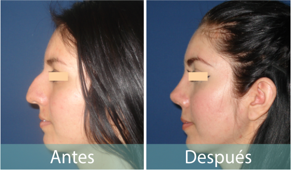 Fotos Antes y Despues