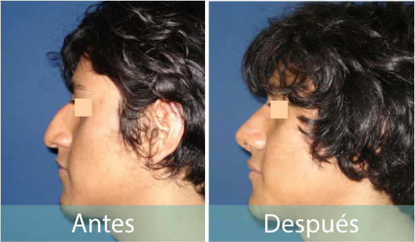 Fotos Antes y Despues